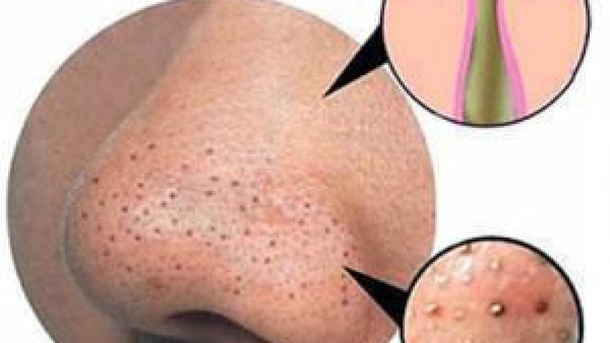 cum poti scapa de punctele negre in doar cateva minute asta e cea mai eficienta metoda