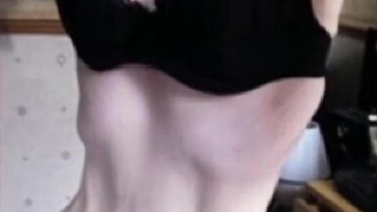 marturiile socante ale unei adolescente de 14 ani care suferea de anorexie ma vedeam dezgustator de