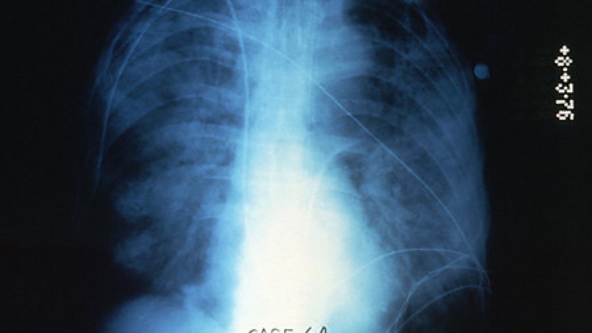 o boala grava face ravagii la new york