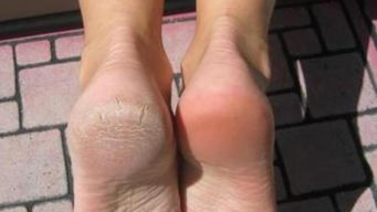 reteta simpla care ne scapa de calcaiele crapate contine doua ingrediente neasteptate