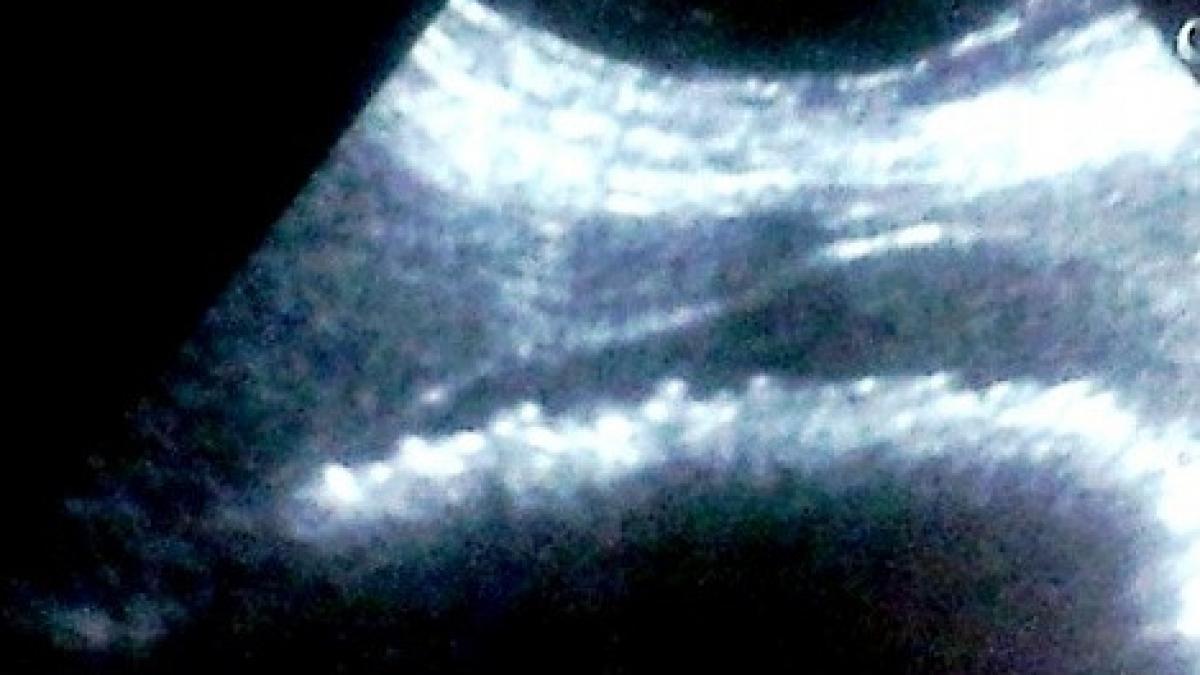 medicii fara cuvinte ce au descoperit in burta unei femei care a ajuns la spital cu dureri