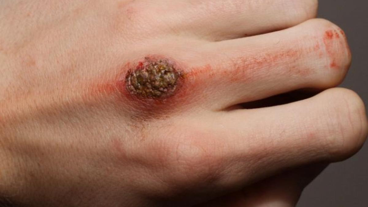 focar de raie la spitalul judetean din ploiesti