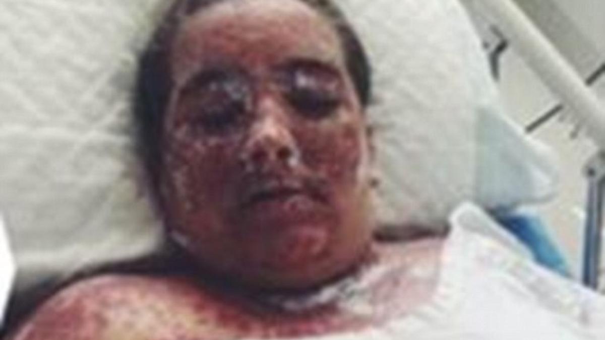 un specialist i a spus sa faca asta pentru a scapa de eczeme rezultatul este oribil sunt plina de