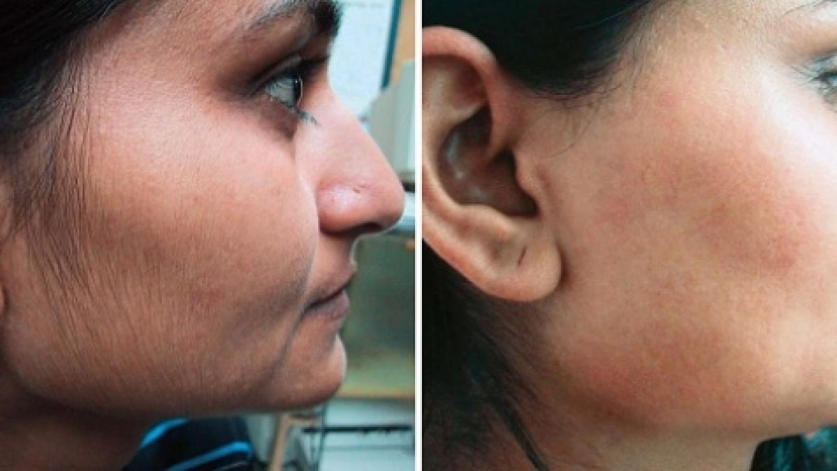 remediul natural facut in casa care te scapa de parul de pe fata fara durere ieftin si eficient