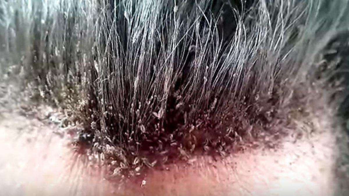 daca nu stai bine cu stomacul nu te uita caz extrem de infestare cu paduchi