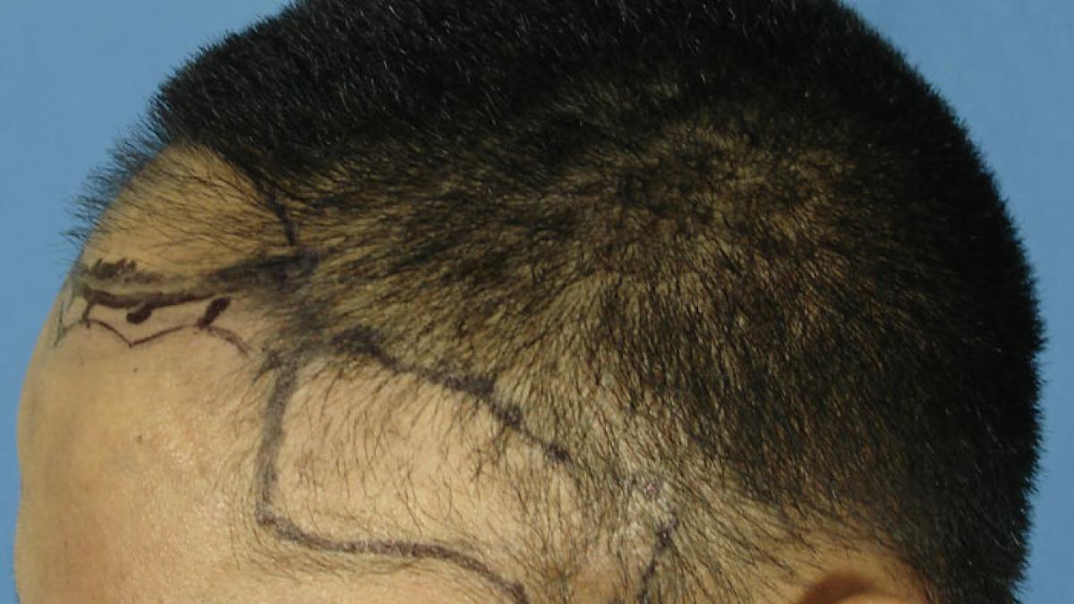 boala grava care poate afecta persoanele care isi tin parul strans in coada imagini avertisment