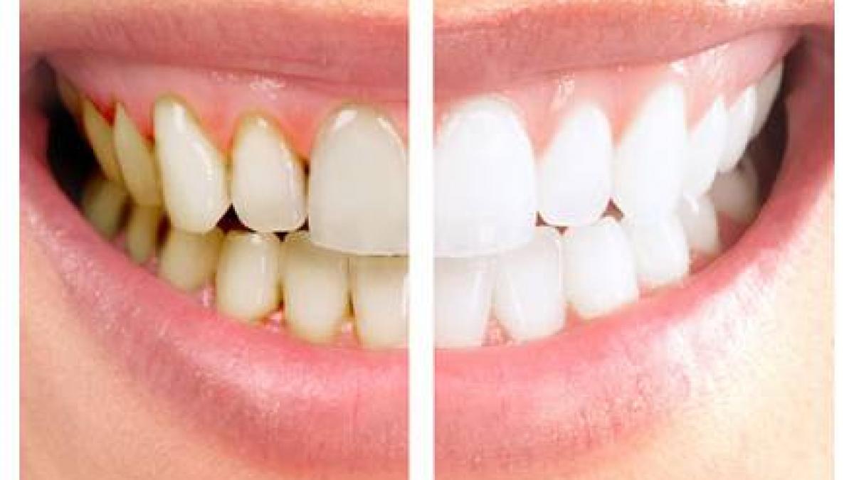 cum sa elimini tartrul fara interventia dentistului