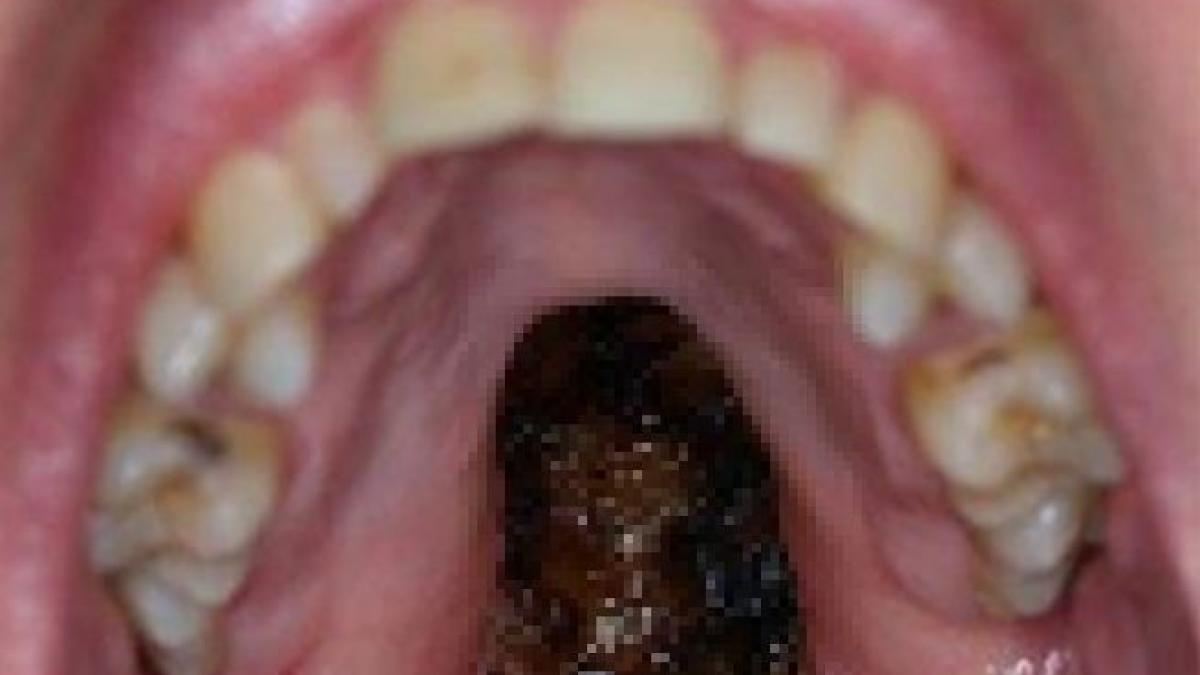 imaginea virala postata de un medic pe facebook cum arata gura unui consumator de cocaina