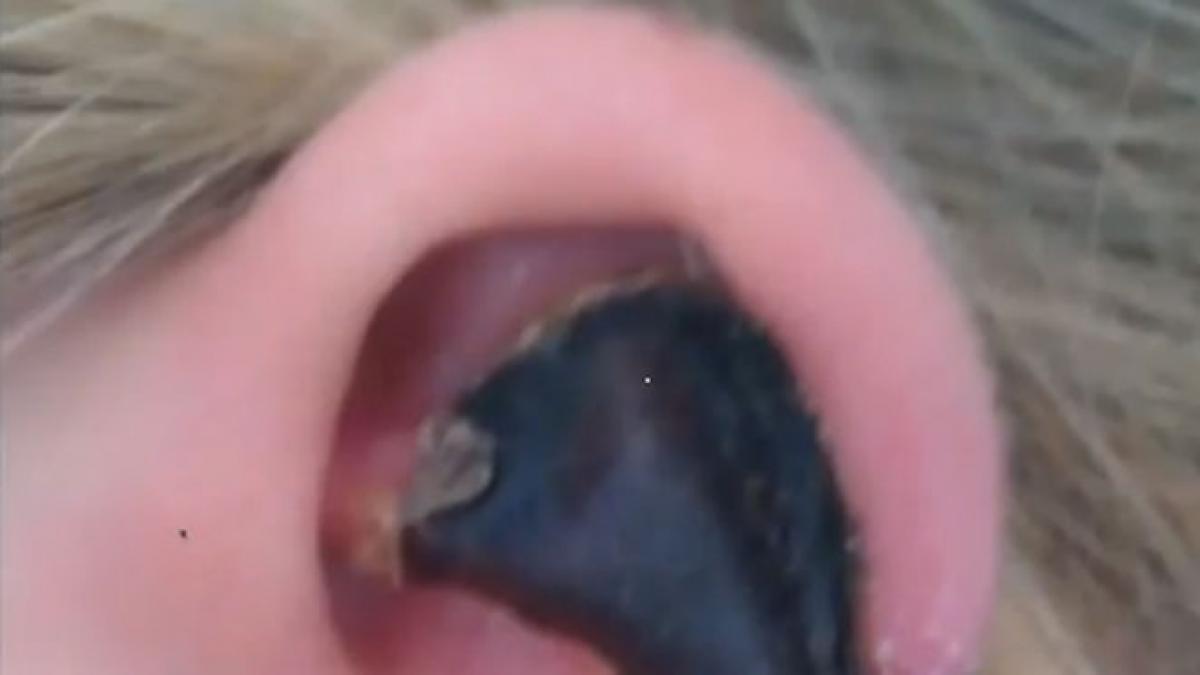 momente de cosmar pentru o turista medicii au fost nevoiti sa i taie o ureche