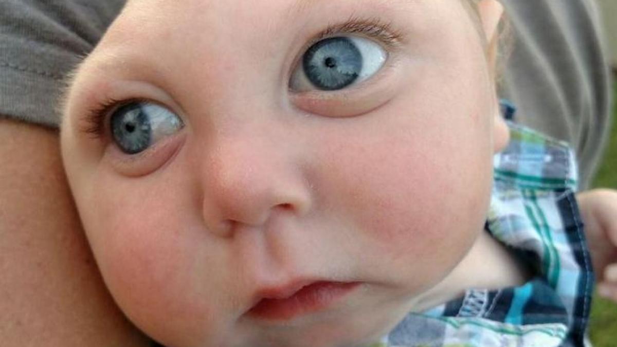 copilul care a uimit medicii s a nascut fara o bucata mare din scalp ce se intampla astazi cu el