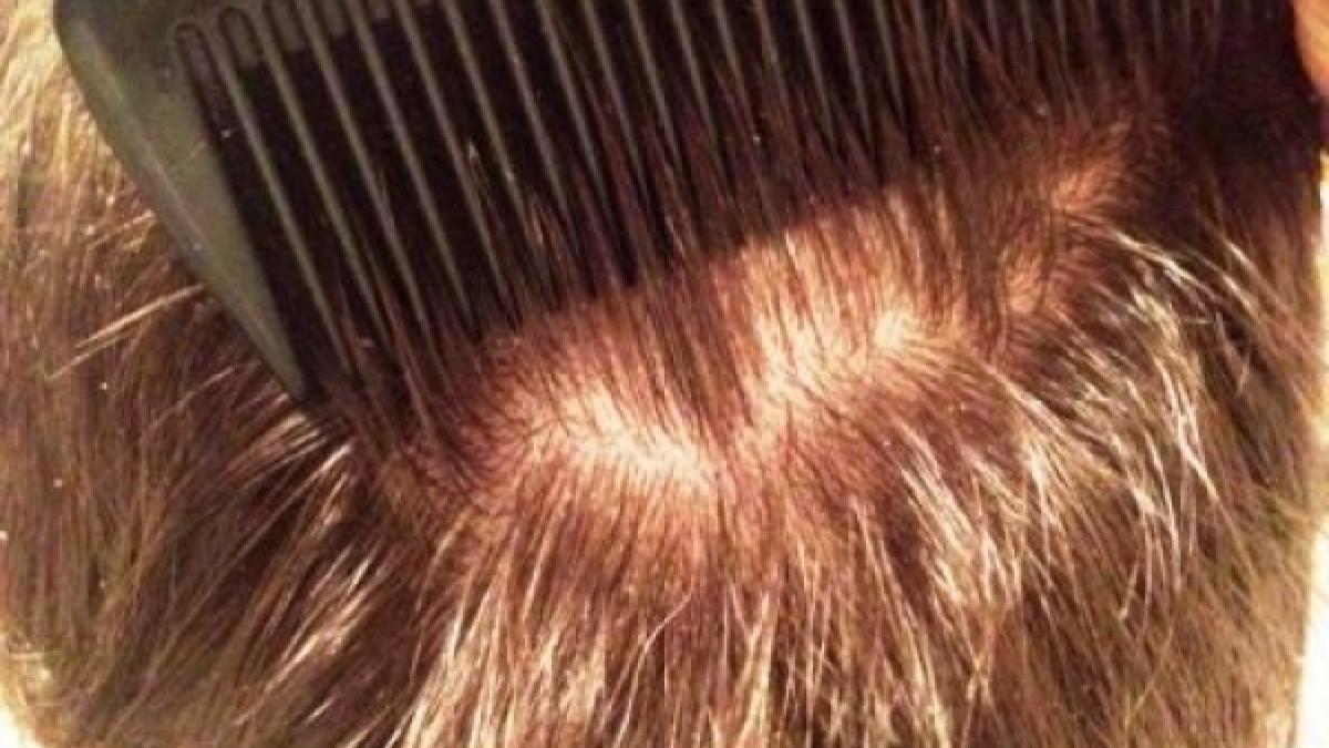 probleme in scoli sute de elevi au fost gasiti cu paduchi