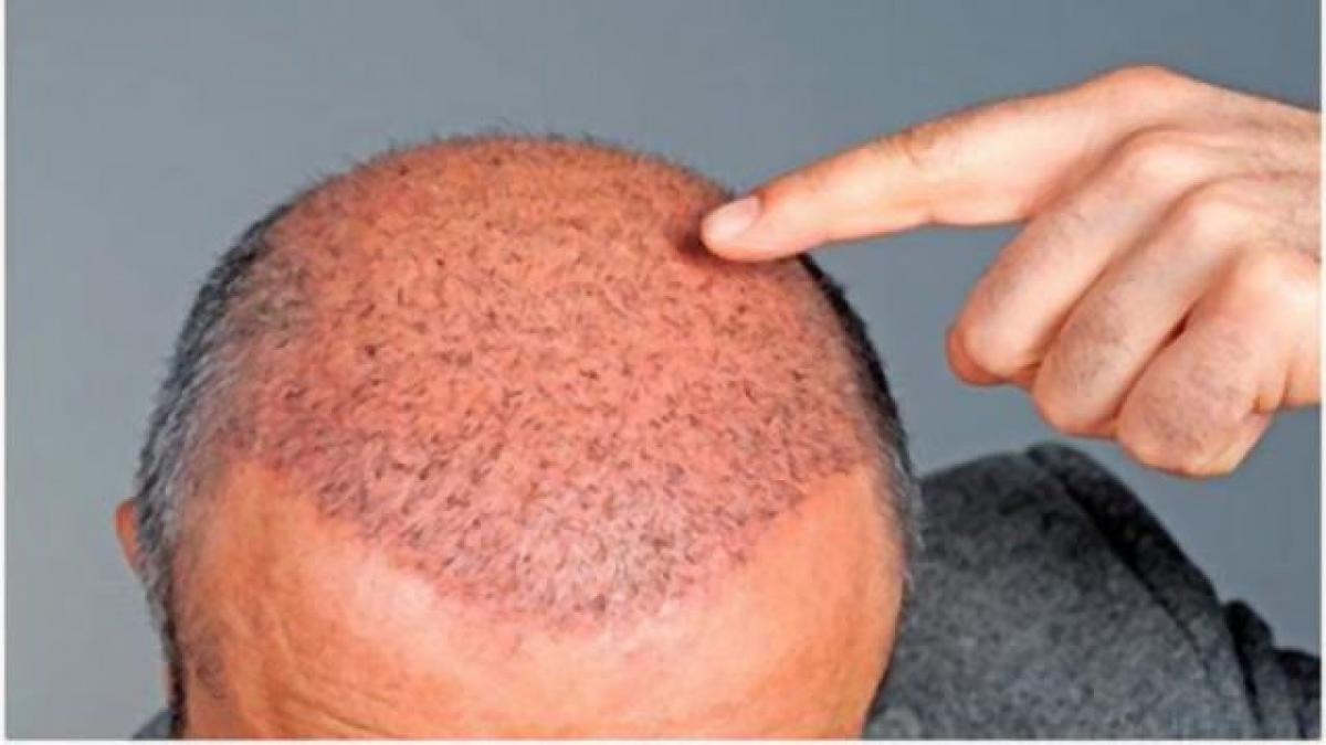 efectul este miraculos reteta de suc de usturoi impotriva caderii parului