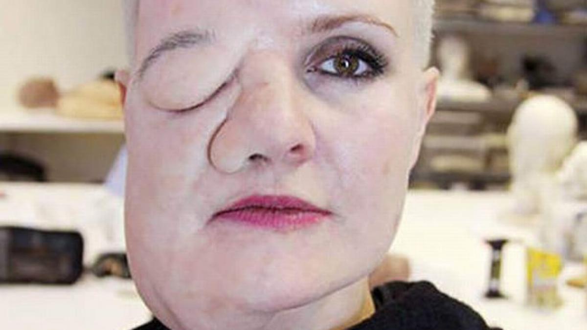 sufera de sindromul urateniei crede ca o tumoare imensa ii acopera jumatate din fata