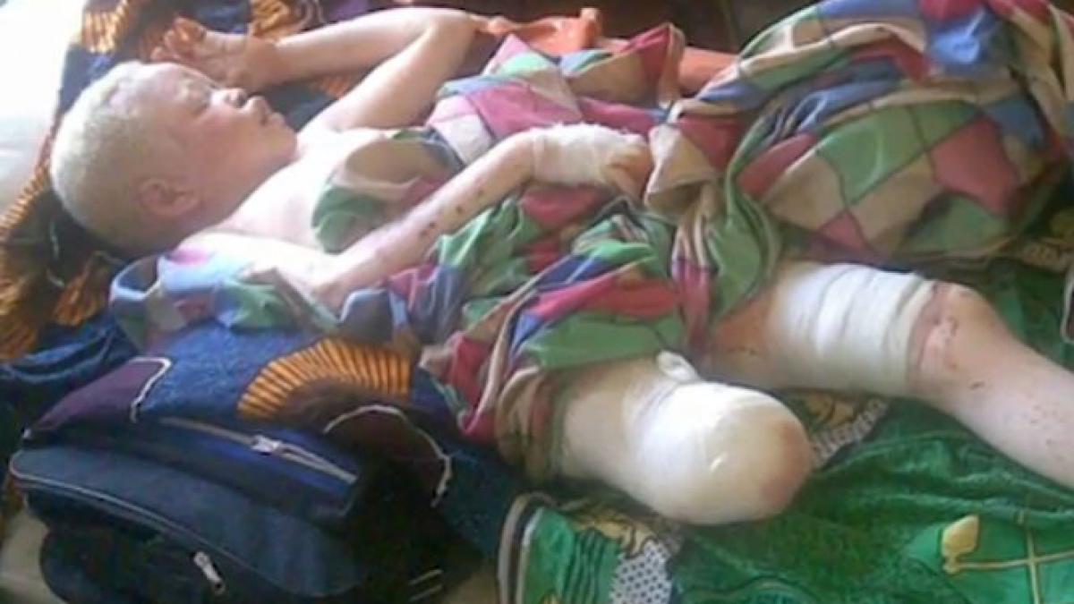 adolescenta atacata pe strada i au taiat un picior si doua degete motivul este halucinant