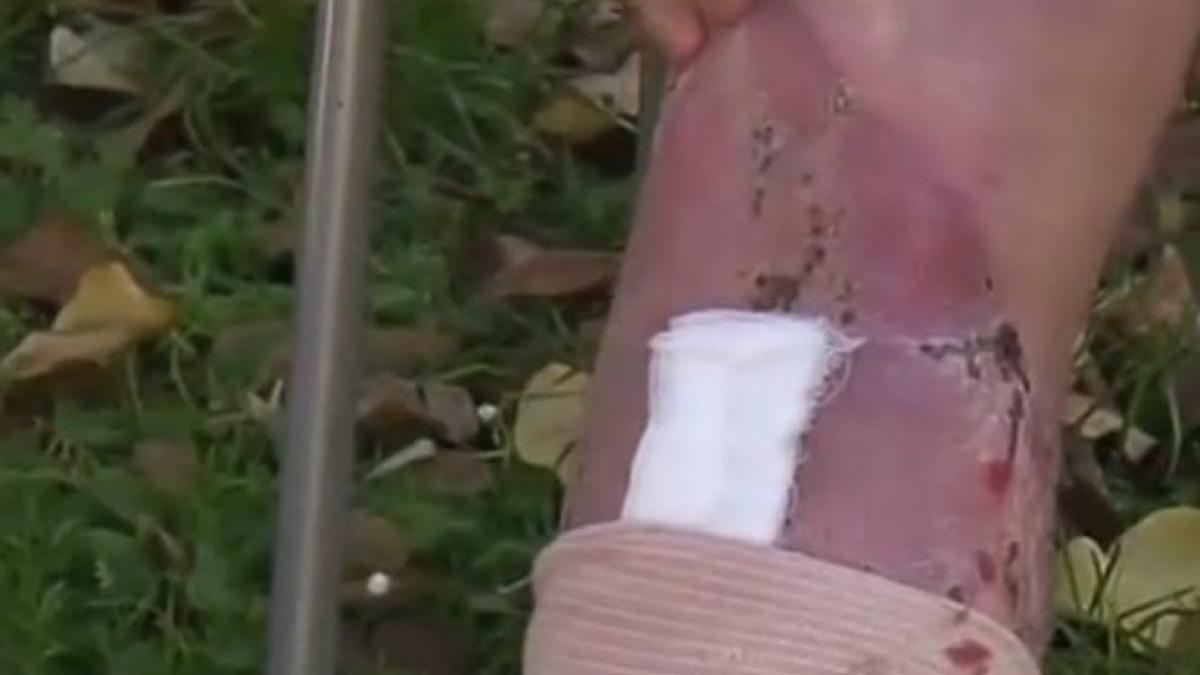 cand mi au deschis piciorul au avut parte de socul vietii lor bacteria ii mancase gamba cazul