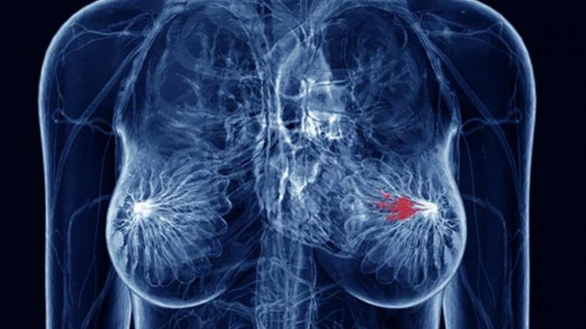 examinari medicale gratuite cancer san