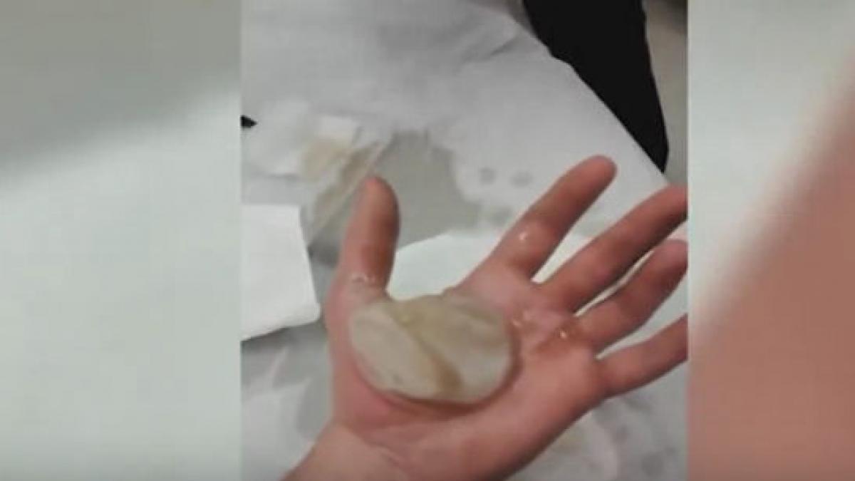 basica arsuri vezicula