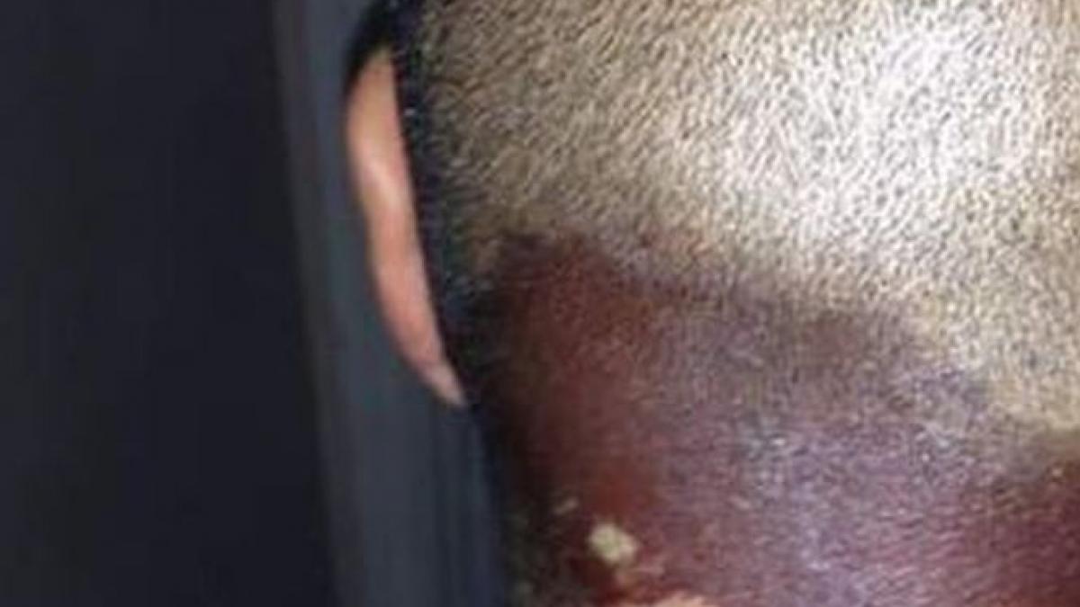 intepatura paianjen sundil dade spital