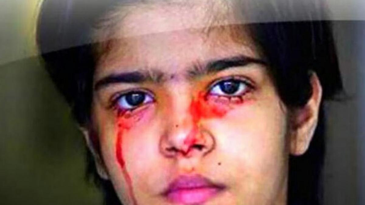 boala lacrimi sange hematidroza