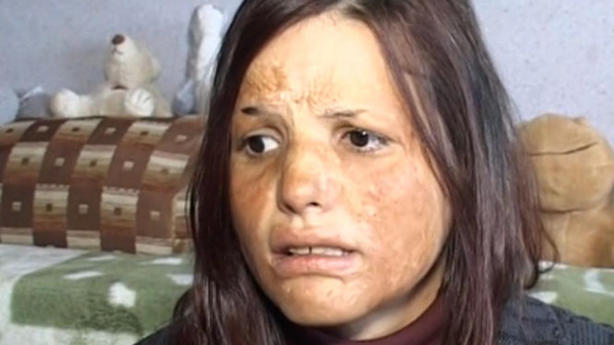 tanara mutilata de foc pictura