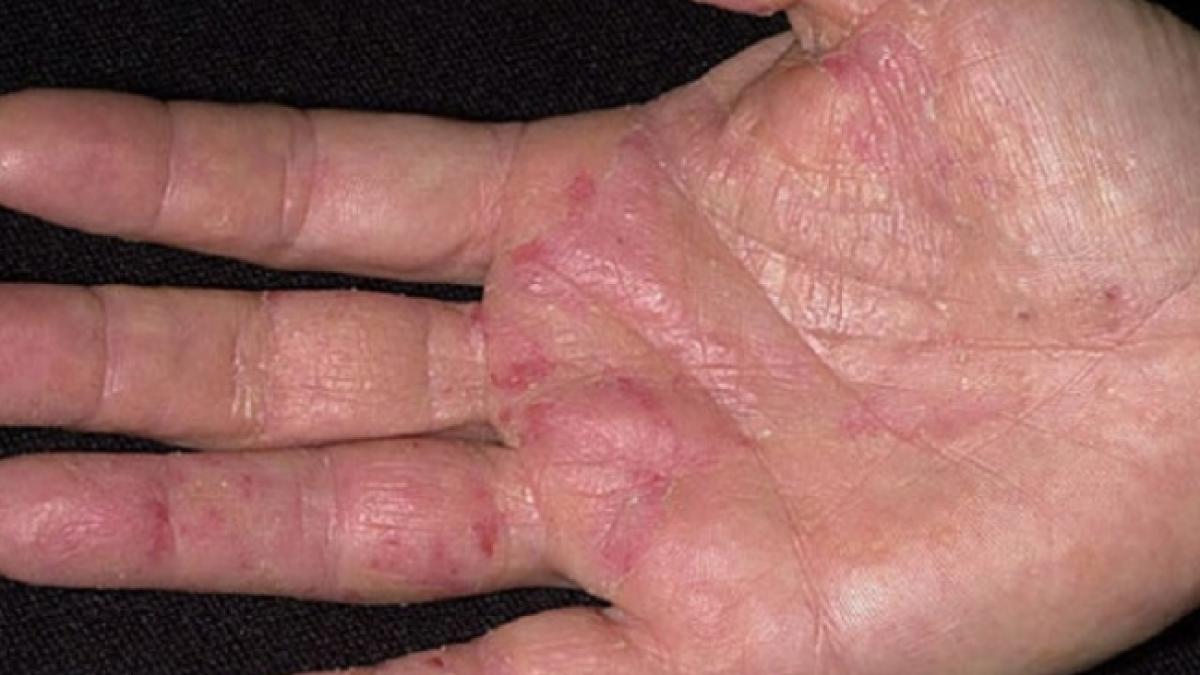 primul semn de cancer apare pe maini nu il ignora