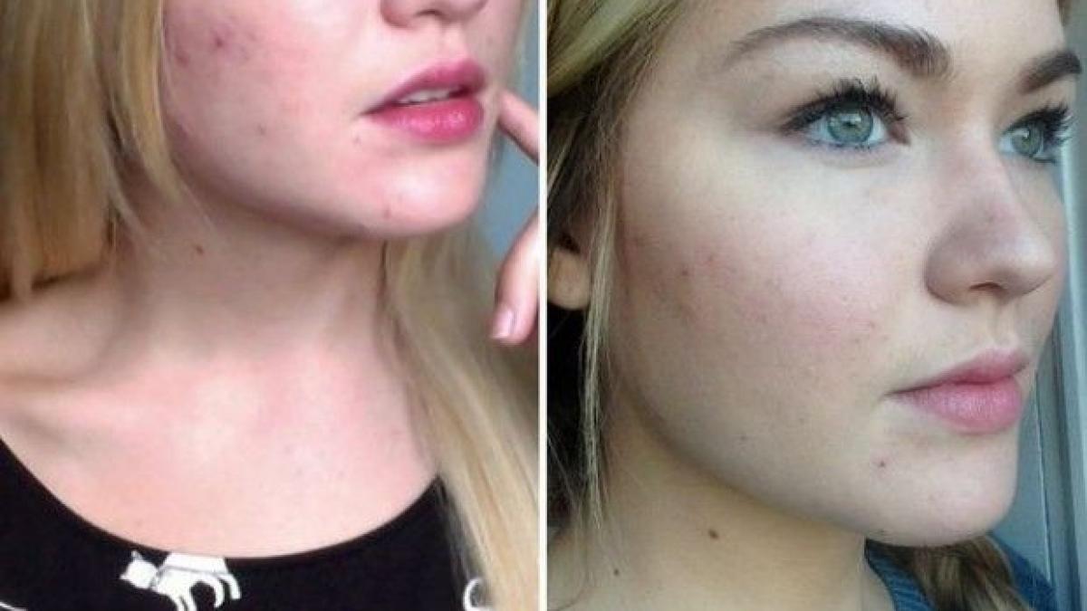 a scapat definitiv de cosuri dupa ce a folosit un produs la indemana oricui transformarea s a vazut