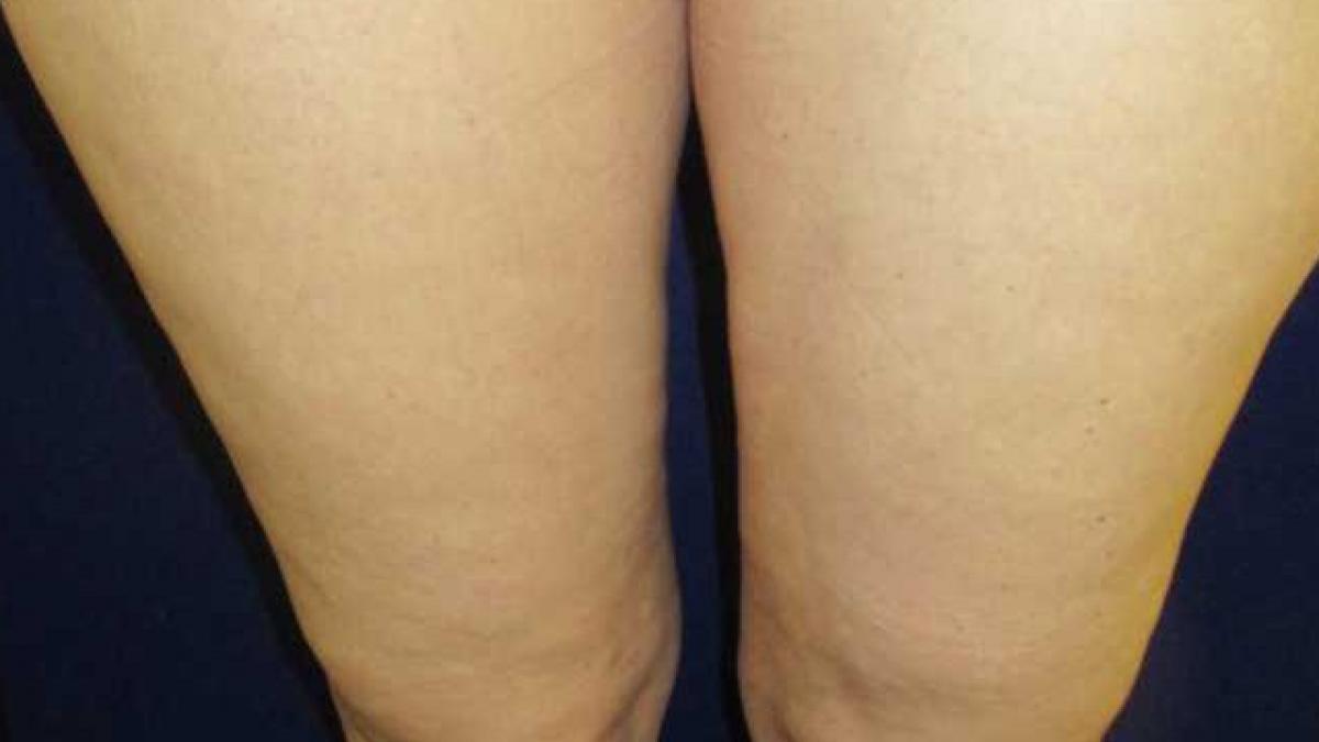 reteta naturala care te scapa de celulita ai nevoie doar de doua ingrediente