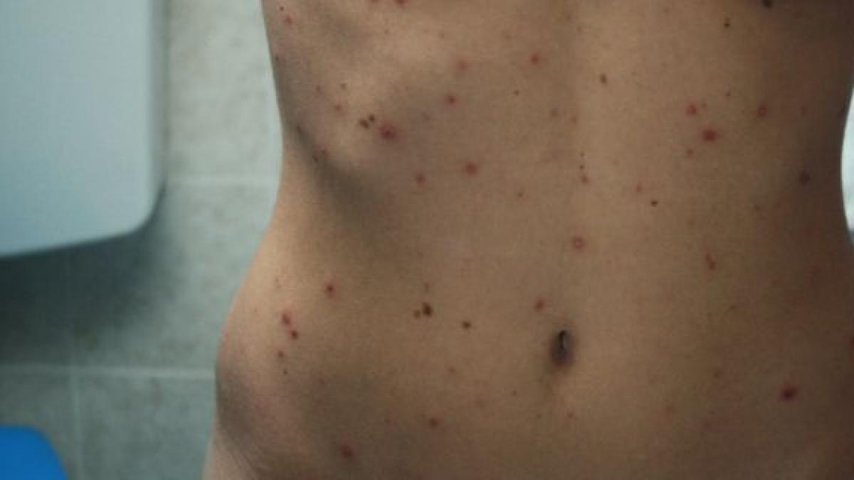 assitenta moarta pitesti varicela