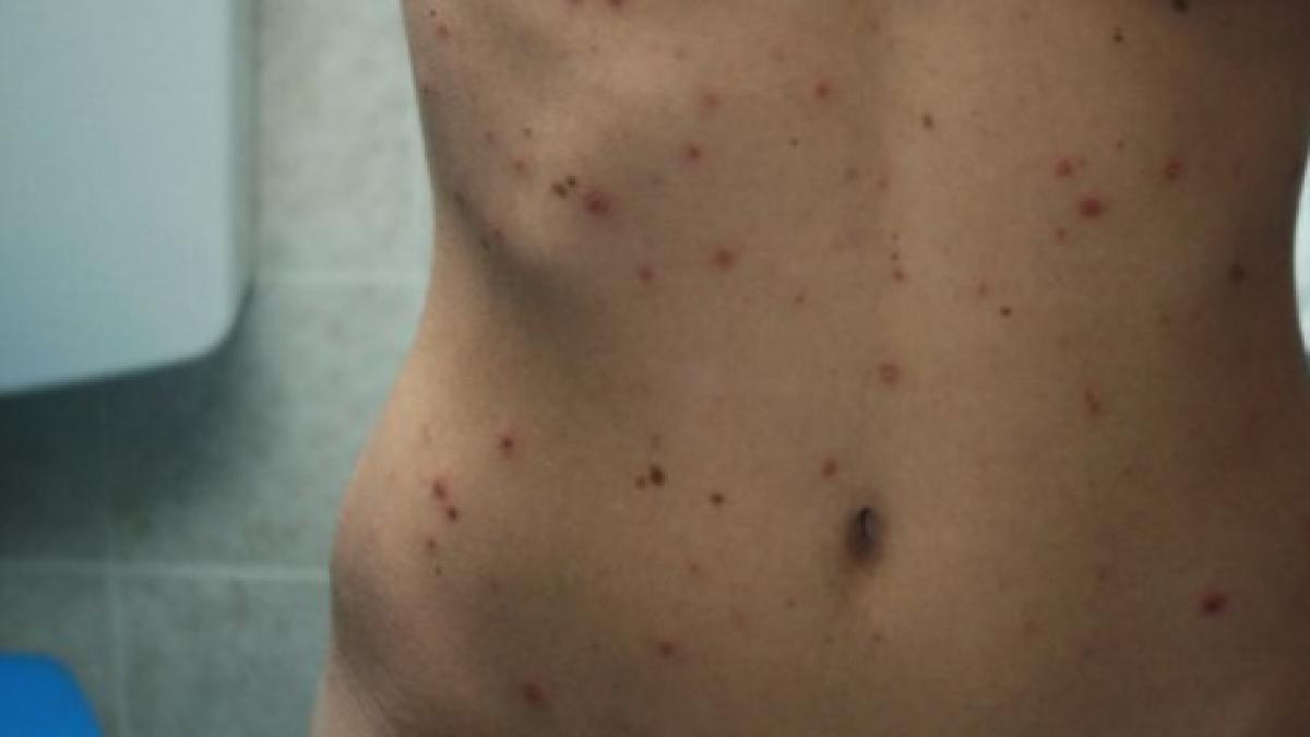 asistenta varicela pitesti