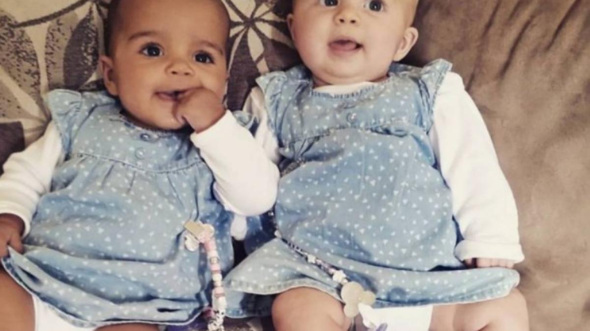 caz extrem de rar gemene cu culoarea pielii diferita