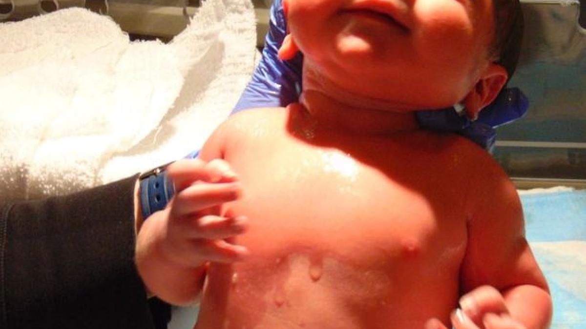 caz medical incredibil fetita s a nascut insarcinata cu gemeni