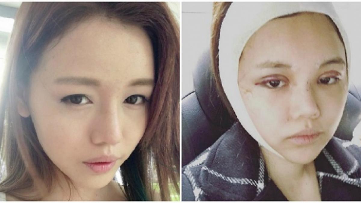 operatii estetice transformare ang chiew ting