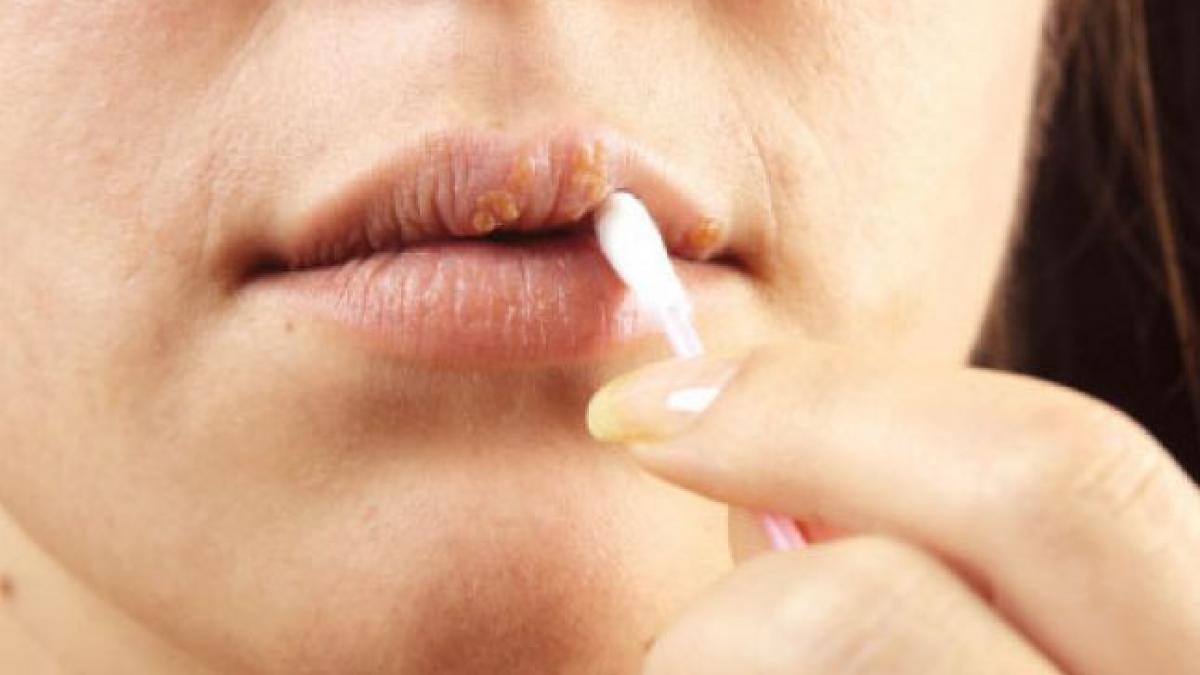 cum sa scapi de herpes simplu si rapid