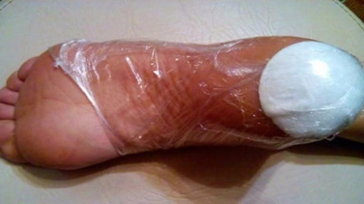 si a lipit o bucata de vata la calcaie noaptea ce s a intamplat dupa 10 zile