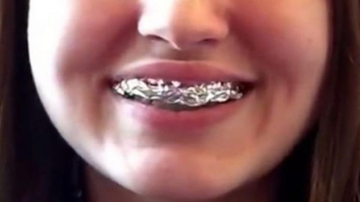incredibil uite ce ti se intampla daca iti invelesti dintii in folie de aluminiu