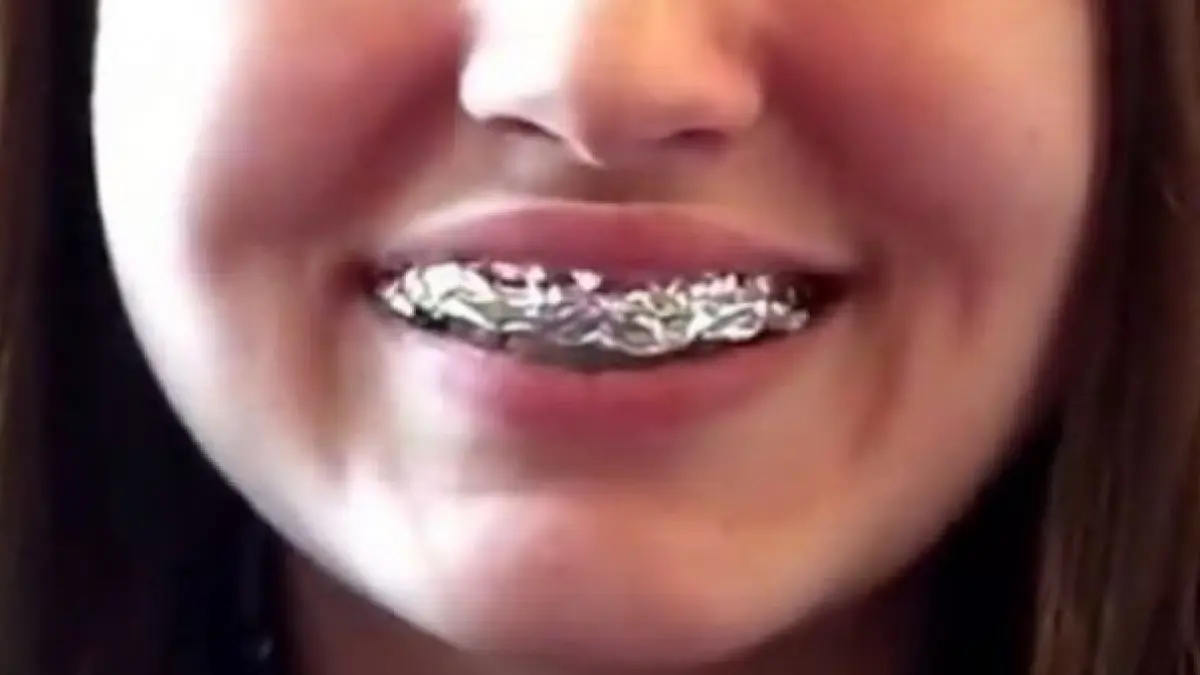 incredibil uite ce ti se intampla daca iti invelesti dintii in folie de aluminiu