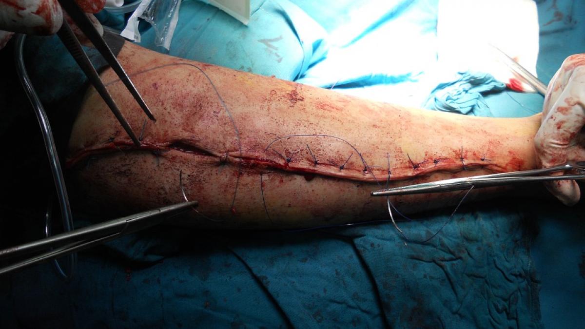 procedura inedita prin care medicii au reusit sa salveze mana unui pacient