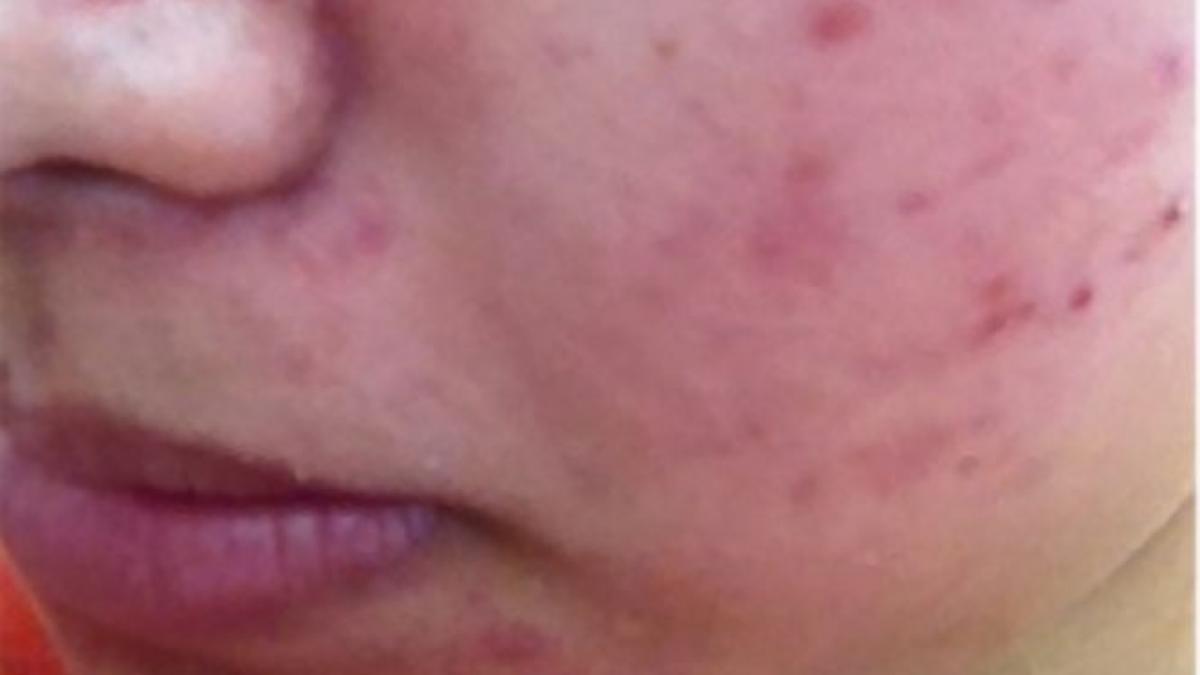 o adolescenta avea fata plina de cosuri afla cum a scapat de ele in doar o saptamana