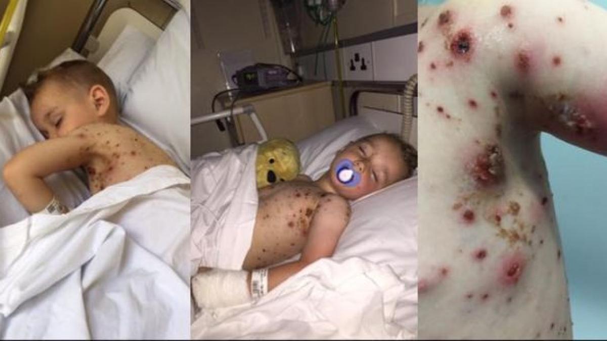 medicamentul pe care sa nu l dai niciodata copilului cand are varicela atentie imagini socante