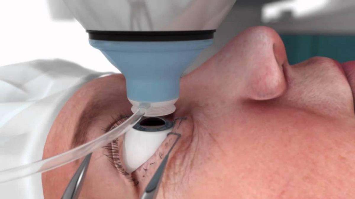 Cataracta operatie laser pe ochi.jpg