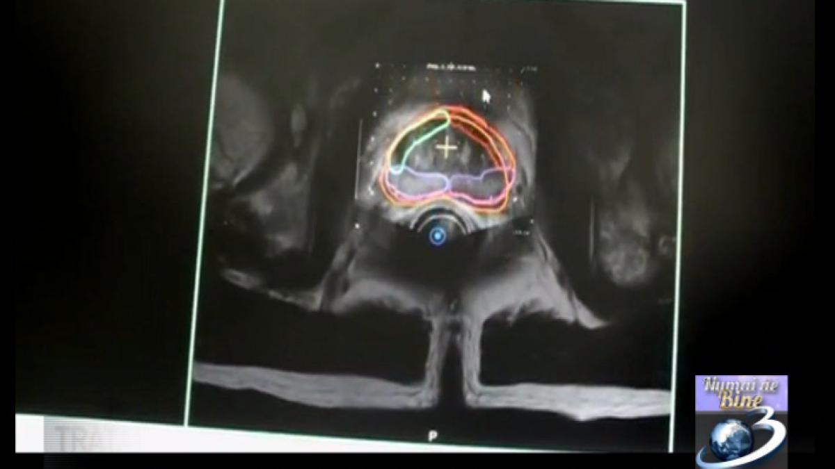 tratament nou pentru cancerul de prostata