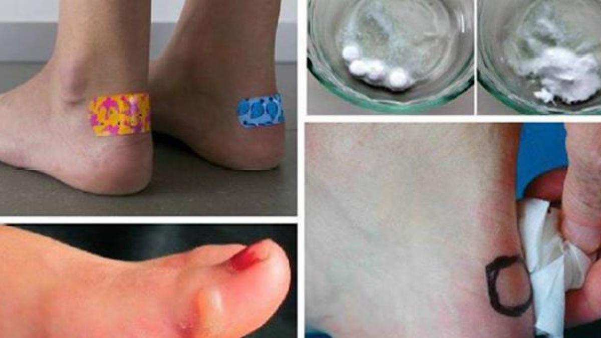 tratament simplu pentru bataturi cum sa te pregatesti pentru vara