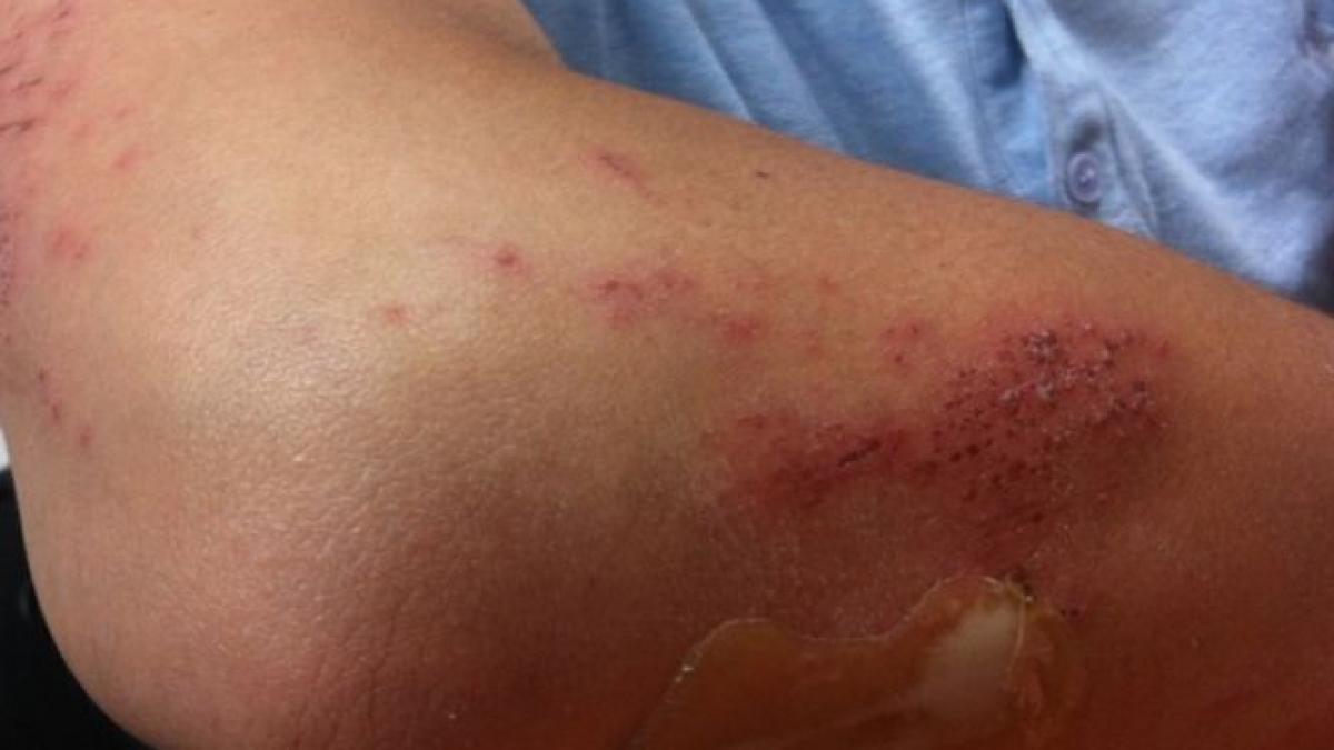 s a trezit intr o dimineata cu vanatai uriase pe tot corpul