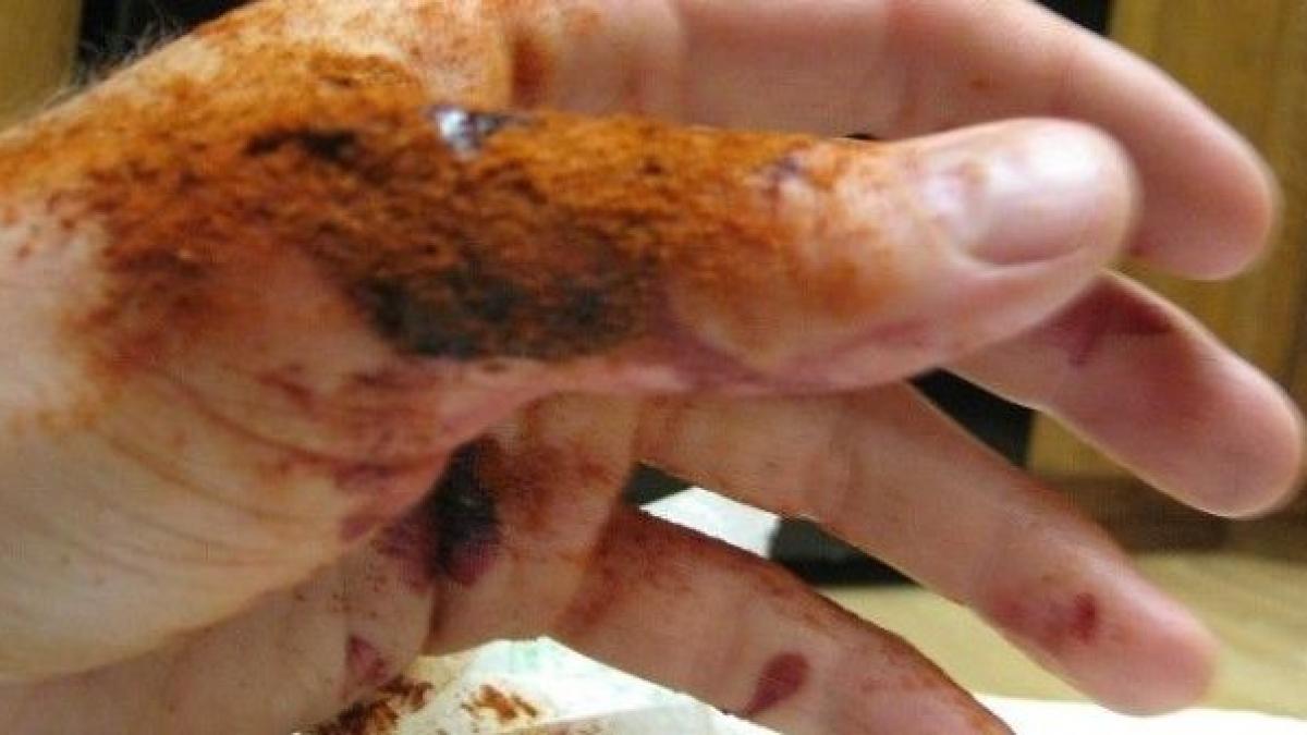 genial cum sa opresti orice sangerare in 10 secunde