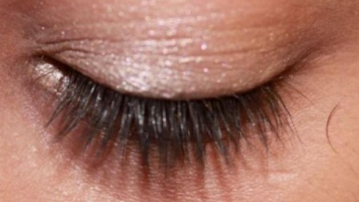 iti cad genele ce boala anunta aceasta anomalie