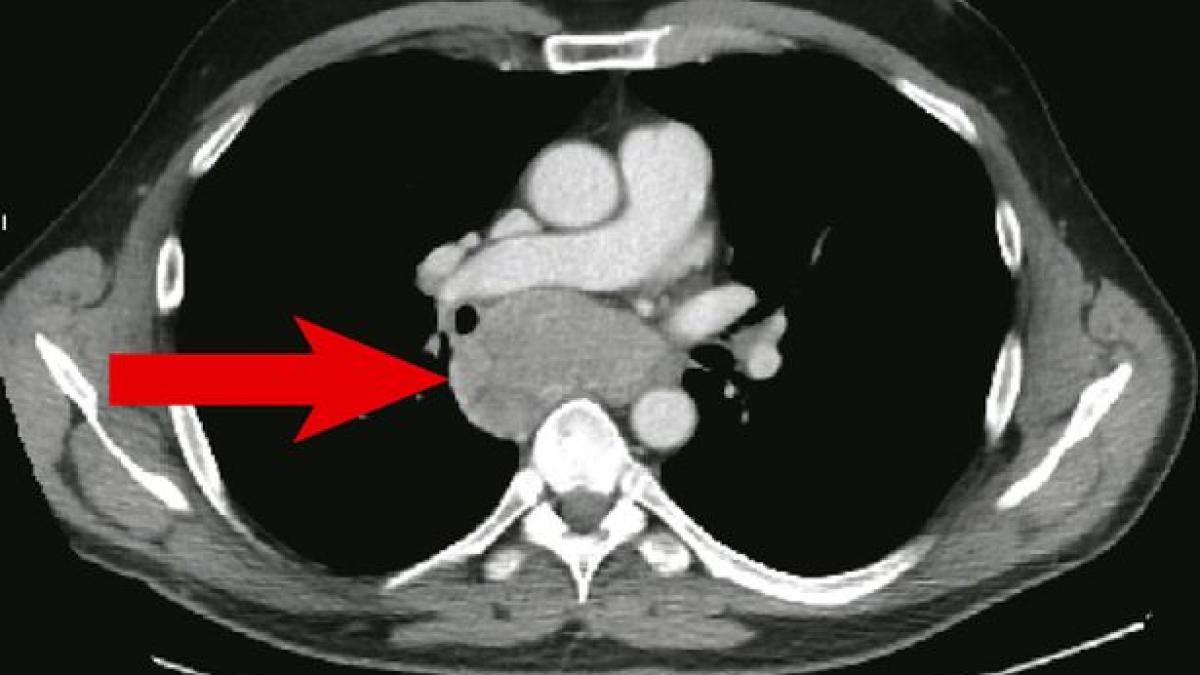avea cancer de piele si era pe moarte