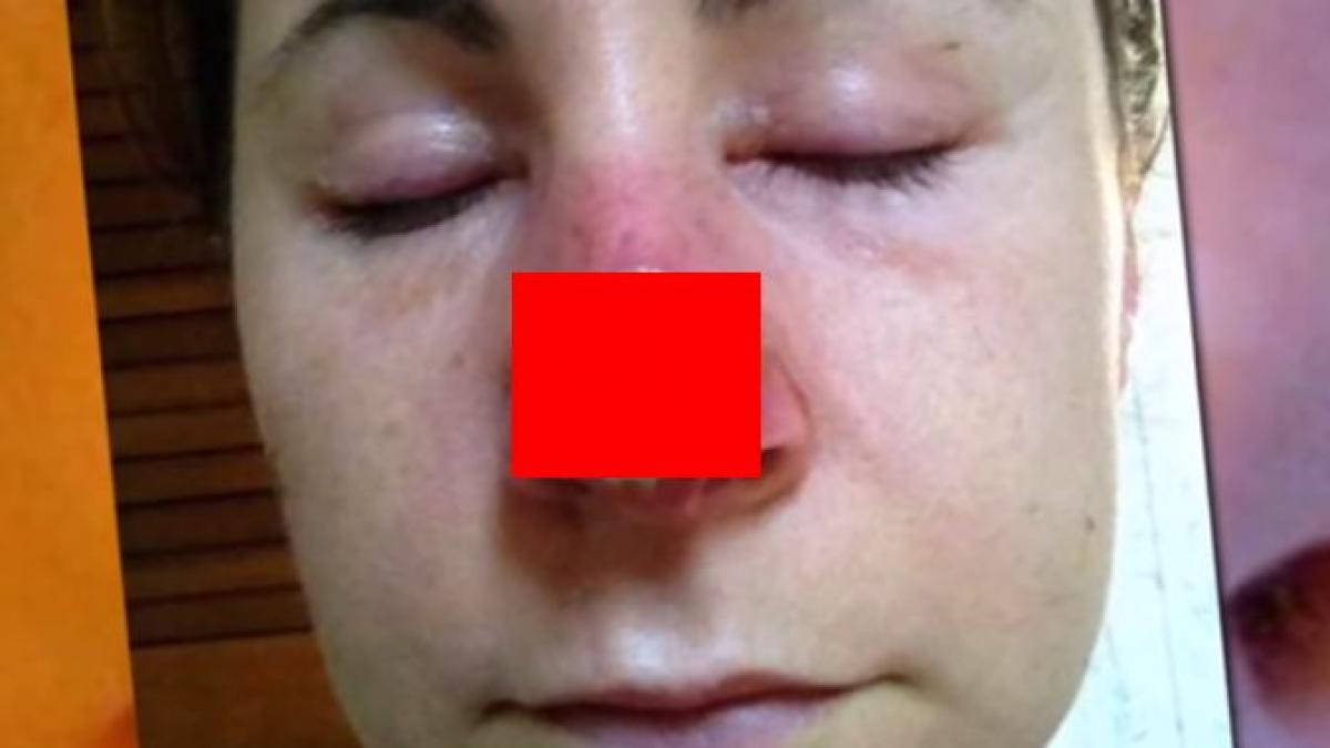 a incercat sa si trateze cancerul cu un produs natural si a ramas fara o bucata din nas