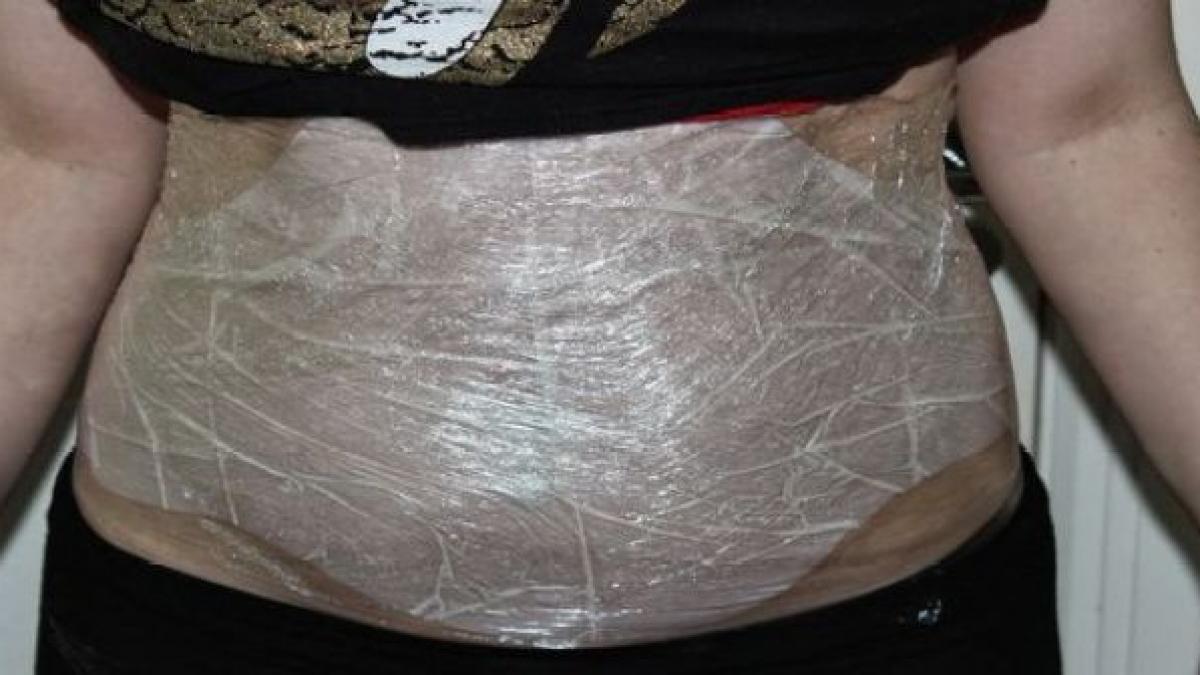 a pierdut aproape 2 cm din circumferinta taliei intr o singura noapte cum este posibil