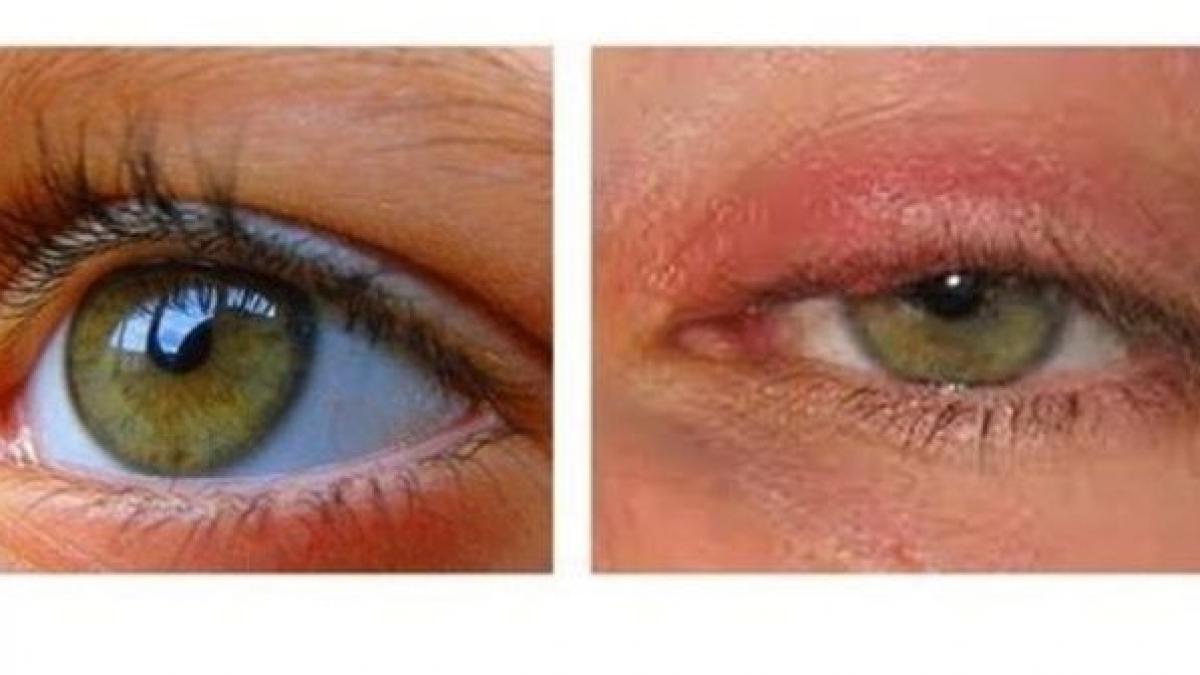 remediu natural incredibil care iti vindeca infectiile ochilor in 24 de ore ce a facut un barbat si