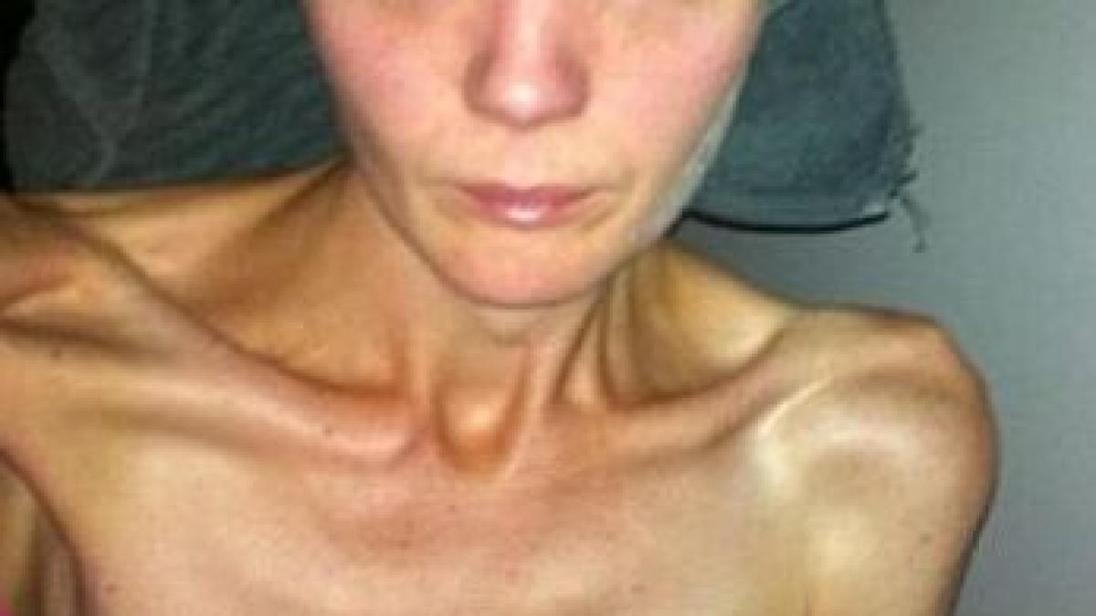 a primit o scrisoare de la mama ei a intrat imediat in depresie si a ajuns anorexica